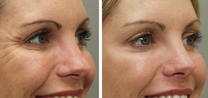 KNOW ABOUT BOTOX FOR WRINKLES